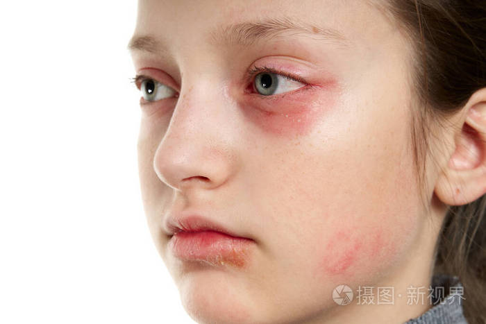 过敏反应皮疹近距离观察一个女孩的脸眼睛和嘴唇皮肤发红和发炎免疫