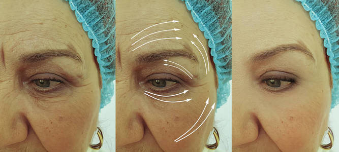 病人 填料 注射 面部 返老还童 保湿 皮肤科 美容学 老化