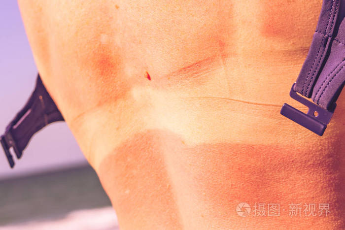 女人背部皮肤晒伤