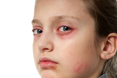 眼睛发红过敏反应,皮疹,近距离观察一个女孩的脸.