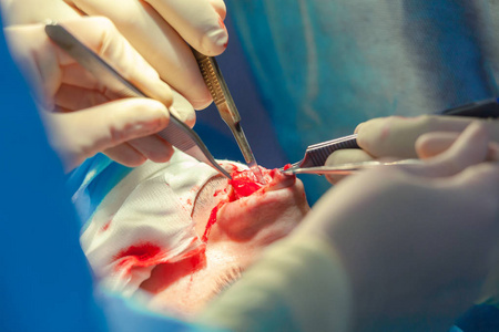 外科医生和他的助手在医院手术室做鼻子整容手术.鼻子整形,隆鼻.