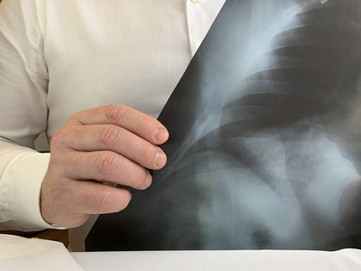 一个穿白衬衫的医生在看x光片.一个男人手里拿着x光胸片.