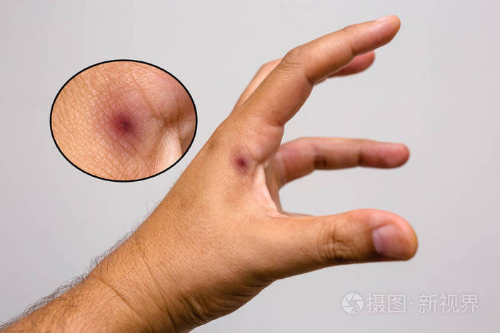 蝎子刺,蝎子毒.