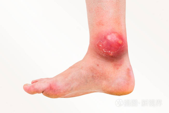 踝关节有痈或疖子的详细视图