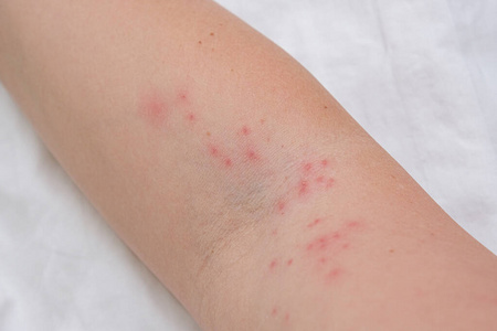 过敏反应引起的瘙痒丘疹,反应,过敏概念和皮肤病学有瘙痒荨麻疹症状的