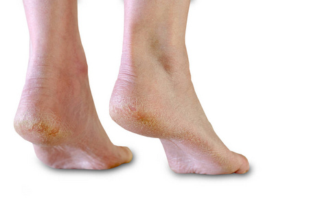 脚后跟干裂口图片