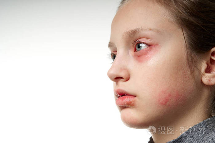 过敏反应皮疹近距离观察一个女孩的脸眼睛和嘴唇皮肤发红和发炎免疫