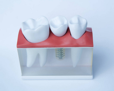 牙科医生牙齿塑形模型，带螺丝钉植入，供教学和牙科诊所的病人展示牙齿和牙龈。