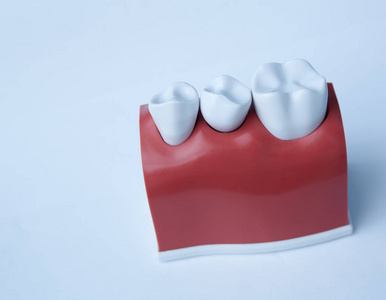 这个模型显示，牙齿已经被封住了，而不锈钢销在牙龈中。