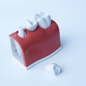 这个模型显示，牙齿已经被封住了，而不锈钢销在牙龈中。