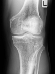 股骨 损伤 科学 半月板 关节炎 腓骨 解剖 关节病 肌腱