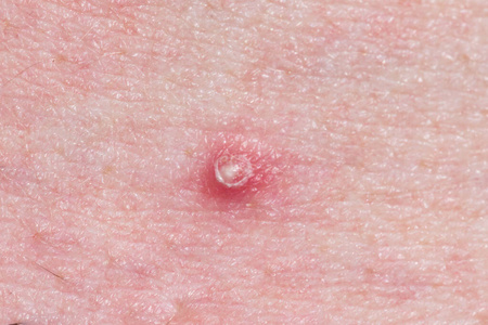 白头粉刺人类皮肤上的白头粉刺.照片