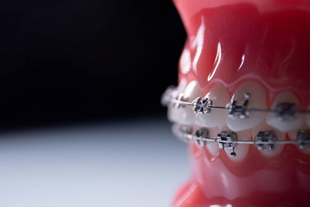 用金属支架对牙齿进行特写。带支架的钳口在表面转动。