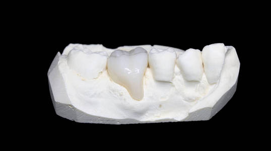 臼齿 牙科 医学 瓷器 假体 义齿 照顾 氧化锆 实验室