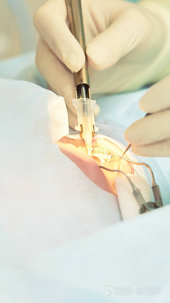 眼科激光显微镜手术门诊医生病人的眼睛治疗近视与白内障摘除术