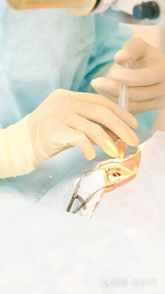 眼科激光显微镜手术门诊医生病人的眼睛治疗近视与白内障摘除术