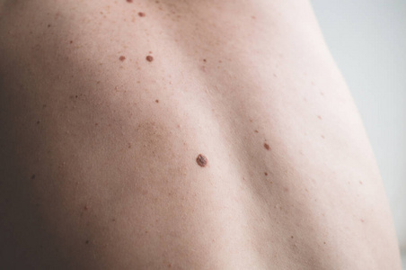 一个男人背部裸露皮肤的特写,上面有散落的痣和雀斑.照片