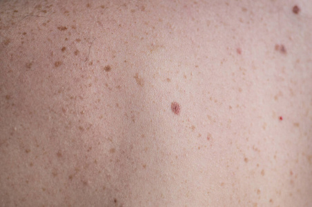 检查良性痣.一个男人背部裸露皮肤的特写,上面有散落的痣和雀斑.照片