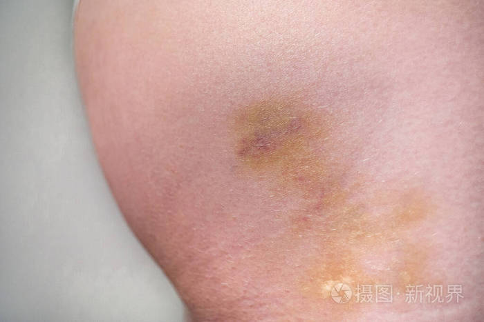 白人女性臀部皮肤瘀伤侧视特写