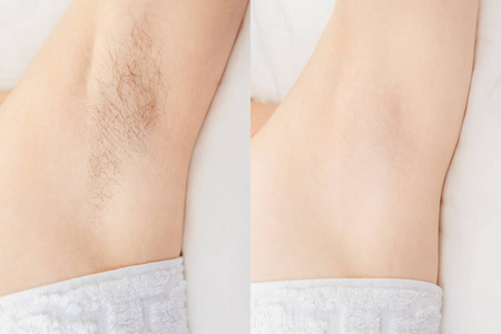 剃须前激光脱毛照片