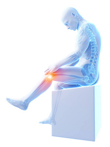 生物学 射线 插图 提供 疼痛 关节病 半月板 解剖 骨骼