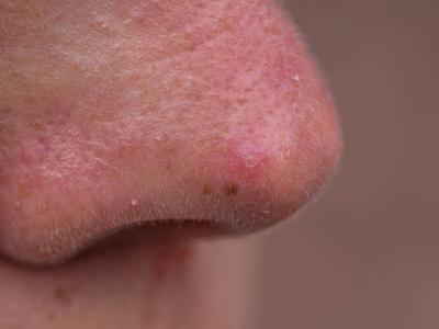 年轻女人的红鼻子照片