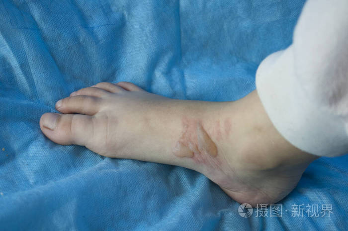 孩子脚上因烫伤而起水泡