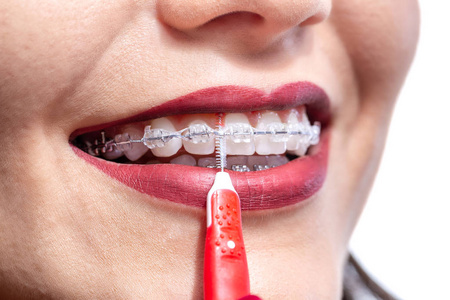 Maintaining oral hygiene and keeping braces clean 