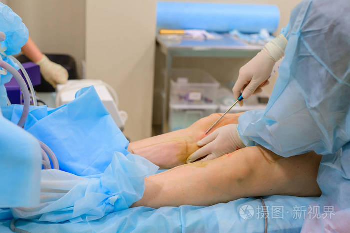 整容手术吸脂去除胖女人腿上脂肪的过程没有脸无法辨认的病人
