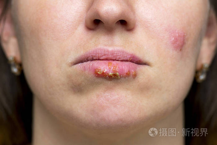 一种常见的疱疹病毒的特写镜头年轻女子嘴唇上有病毒疱疹的一部分