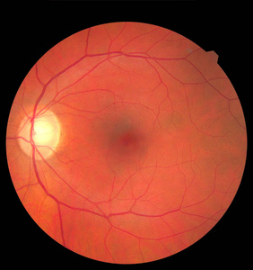 眼科检查,糖尿病视网膜病变,armd照片