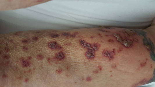 受伤妇女腿部皮肤上的特写瘀伤破裂出血的指甲伤口愈合皮疹化疗副作用