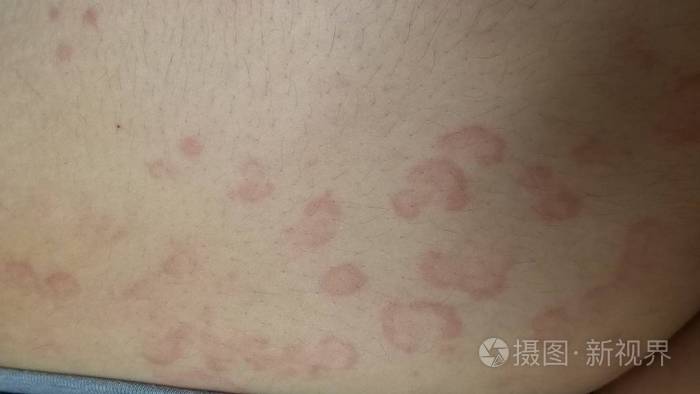 多形红斑环状红斑靶向性皮损