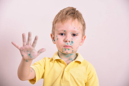 幼儿，水痘男孩。水痘患儿。水痘病毒或水痘泡疹儿童身体和脸。