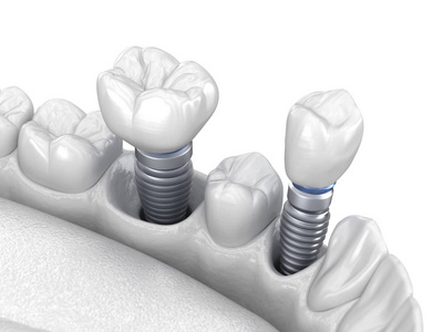 牙齿 安装 王冠 臼齿 假肢 恢复 外科手术 插图 提供