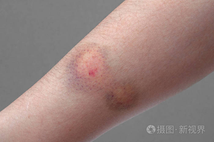 一个女人手臂上的彩色瘀伤的特写镜头