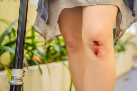膝盖受伤的年轻女子从摩托车上摔了下来照片