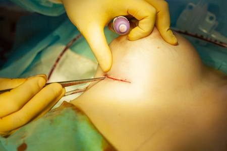 乳房成形术后,医生用外科器械缝合照片