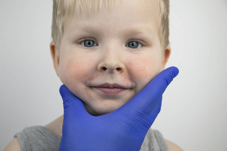 医院 过敏 感染 小孩 脸颊 粉刺 素质 诊断 面对 白种人