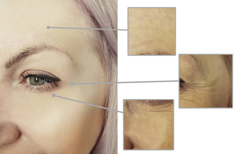 差异 皮肤 年龄 眼睑成形术 再生 塑料 眼睛 整容 程序