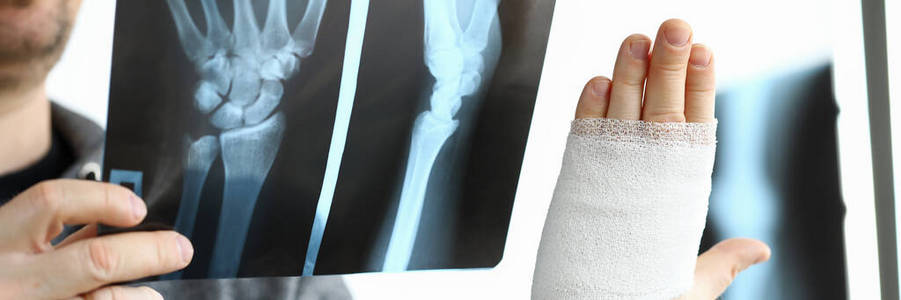 男性病人手臂骨折的手持CT扫描