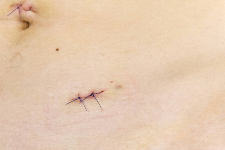 腹腔镜手术的疤痕图片