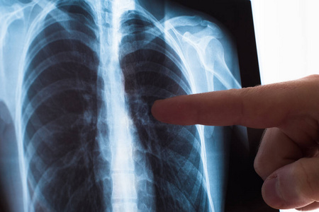 肺部造影概念。放射科医生检查病人肺癌或肺炎的胸部x光片。病毒和细菌感染了人的肺。肺癌或肺炎患者。