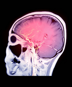 脑血管 神经病学 成像 疾病 病人 动脉 出血 检查 脑内