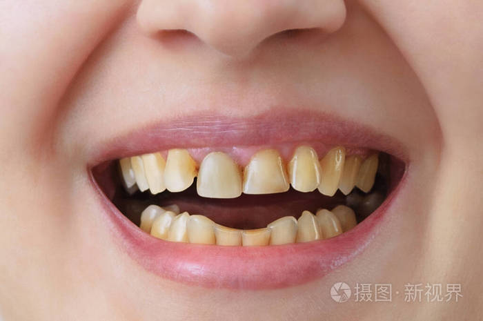 白种人 诊所 正畸医生 面孔 龋病 曲线 治疗 变白 牙齿