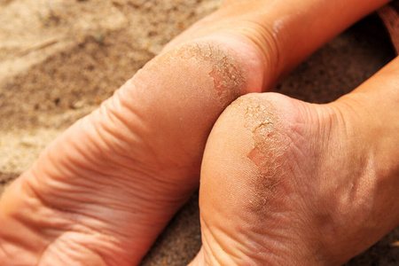 脚后跟 条件 疤痕 疼痛 光秃秃的 女人 强调 照顾 真菌