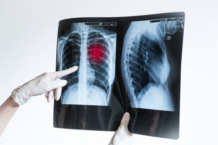 Doctors hands holding xray photo of lungs showing disease. Covi