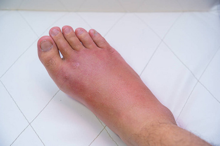 损伤 健康 伤害 积累 扭伤 照顾 脚趾 距骨 成人 偏离
