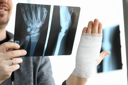 骨折病人男性病人手臂骨折的手持ct扫描照片