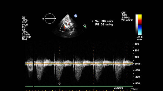 超声心动图 动脉 主动脉 病人 形象 多普勒 尖点 二尖瓣